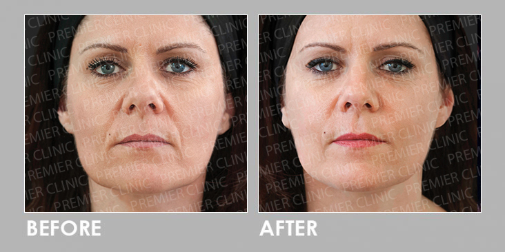 ELLANSE DERMAL FILLER Before After