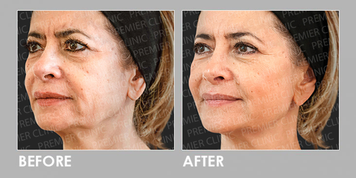 ELLANSE DERMAL FILLER Before After