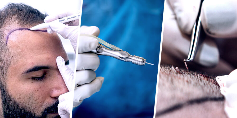 Premier FUE Hair Transplant