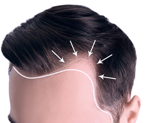 PREMIER CLINIC HAIR LOSS TREATMENTS