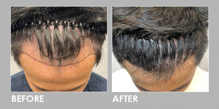 FUE Hair Transplant Before & After