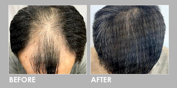 FUE Hair Transplant Before & After