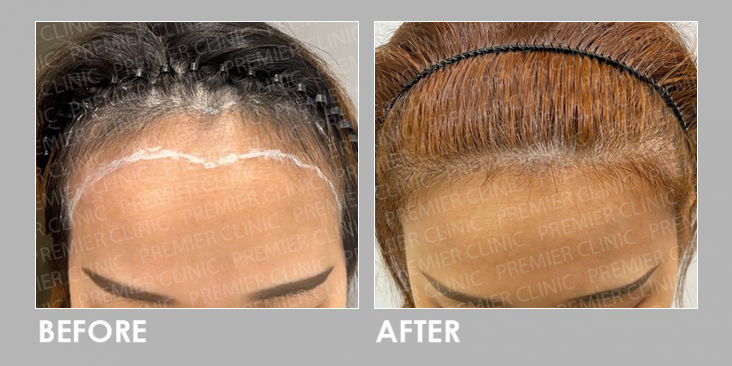 FUE Hair Transplant Before & After
