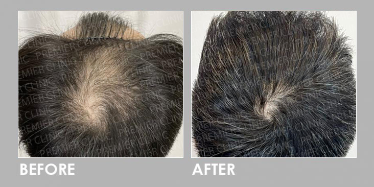 FUE Hair Transplant Before & After