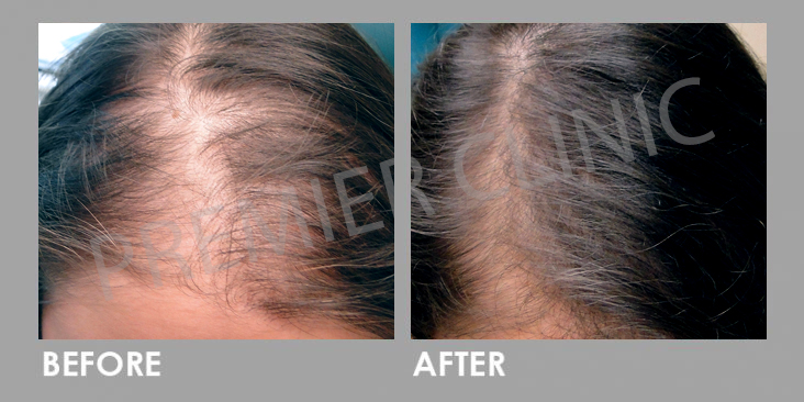 Before & After FUE Hair Transplant for Hair Loss