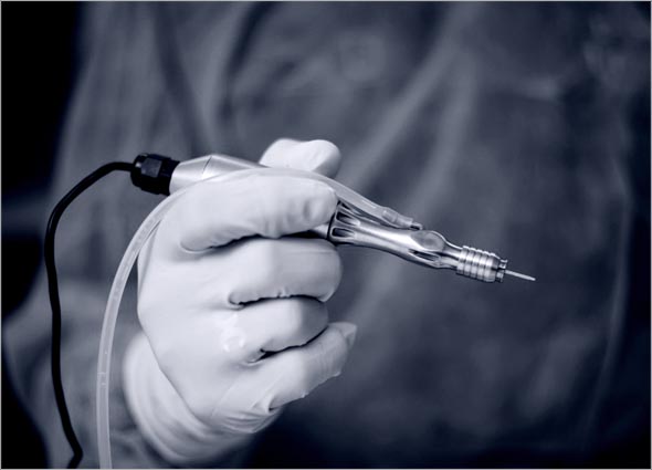 FUE Hair Transplant for Hair Loss