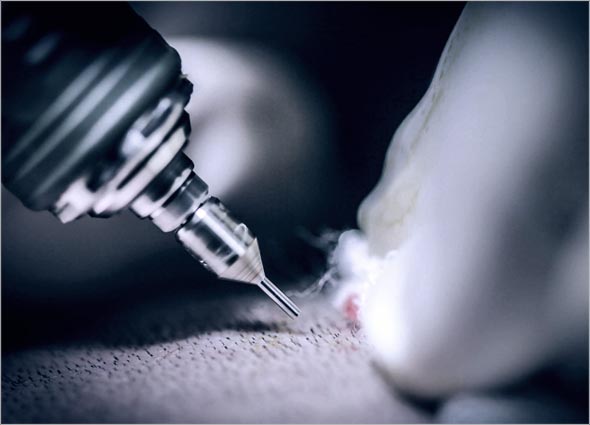 FUE Hair Transplant for Hair Loss