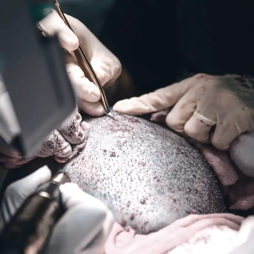premier fue hair transplant