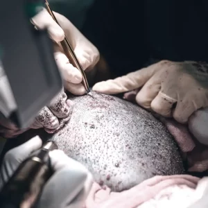 premier fue hair transplant