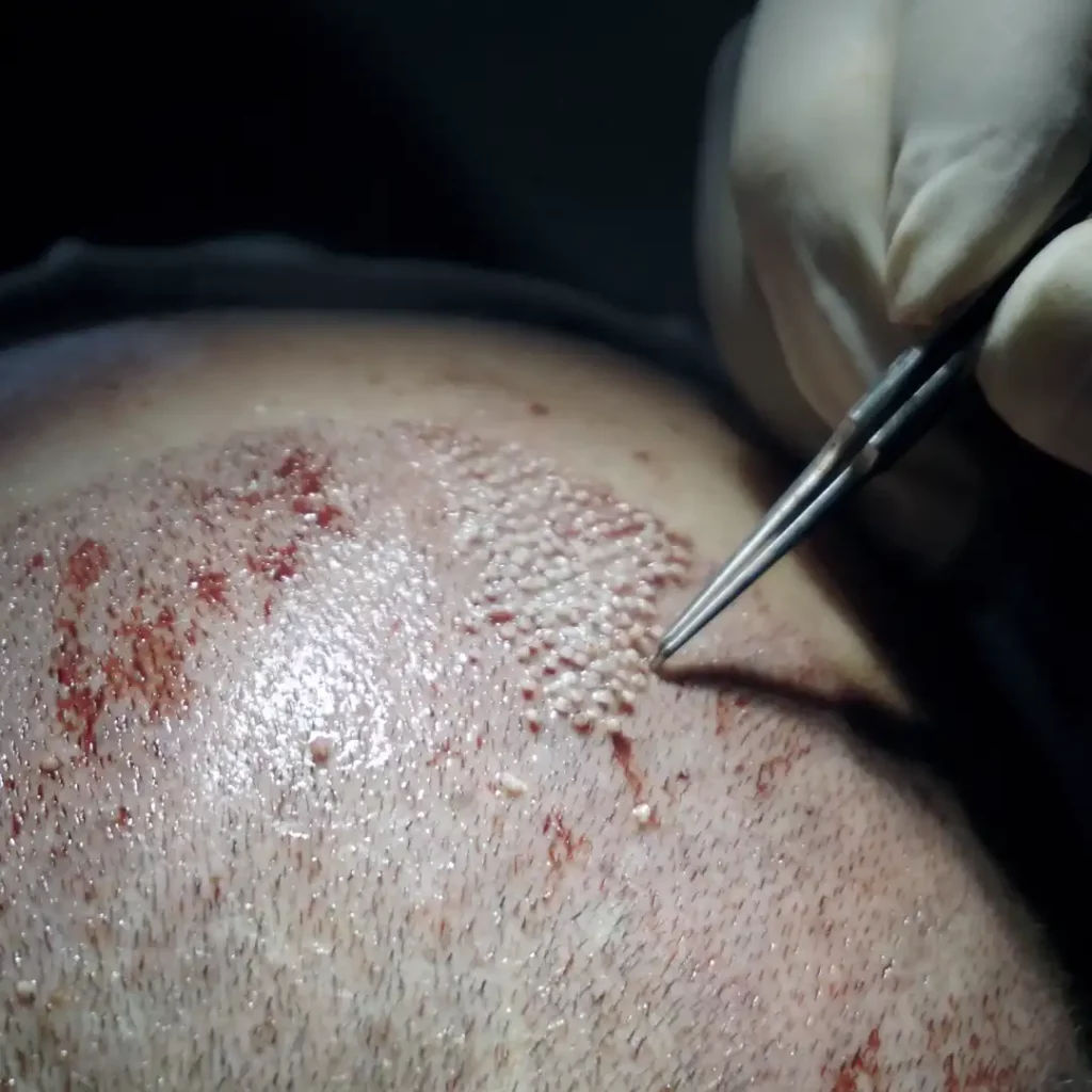 premier fue hair transplant