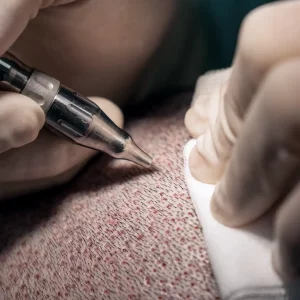premier fue hair transplant