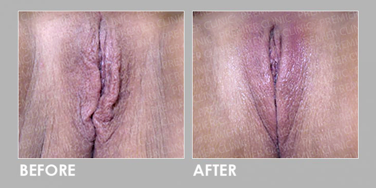 Filler Injections for Vaginal Rejuvenation