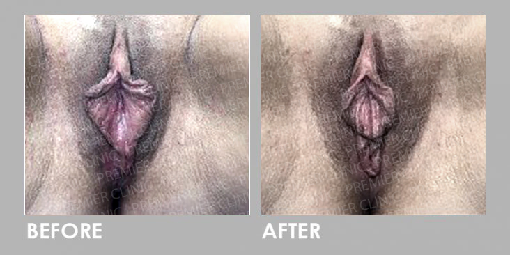 Filler Injections for Vaginal Rejuvenation