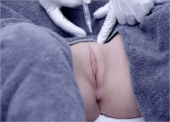 FILLER INJECTIONS FOR VAGINAL REJUVENATION