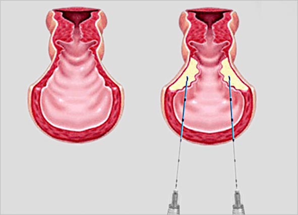 FILLER INJECTIONS FOR VAGINAL REJUVENATION