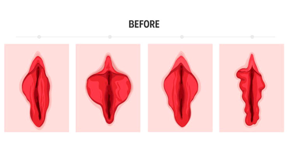 FILLER INJECTIONS FOR VAGINAL REJUVENATION