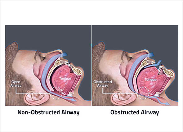 Fotona Laser Snoring Treatment