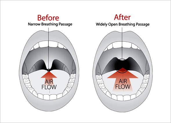 Fotona Laser Snoring Treatment