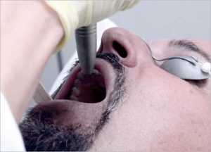 Fotona Laser Snoring Treatment