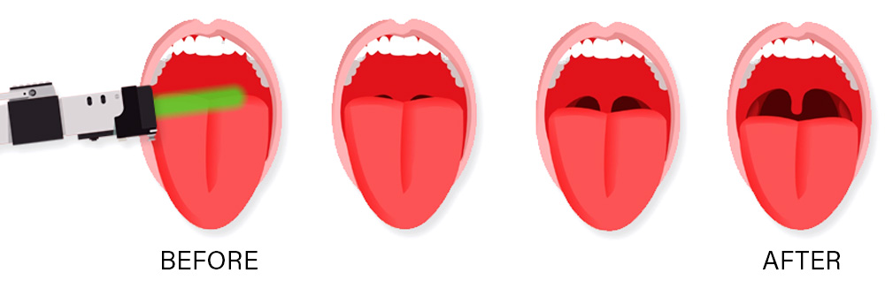 Fotona Laser Snoring Treatment