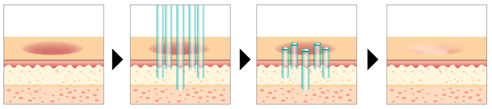 Fractional CO2 Laser