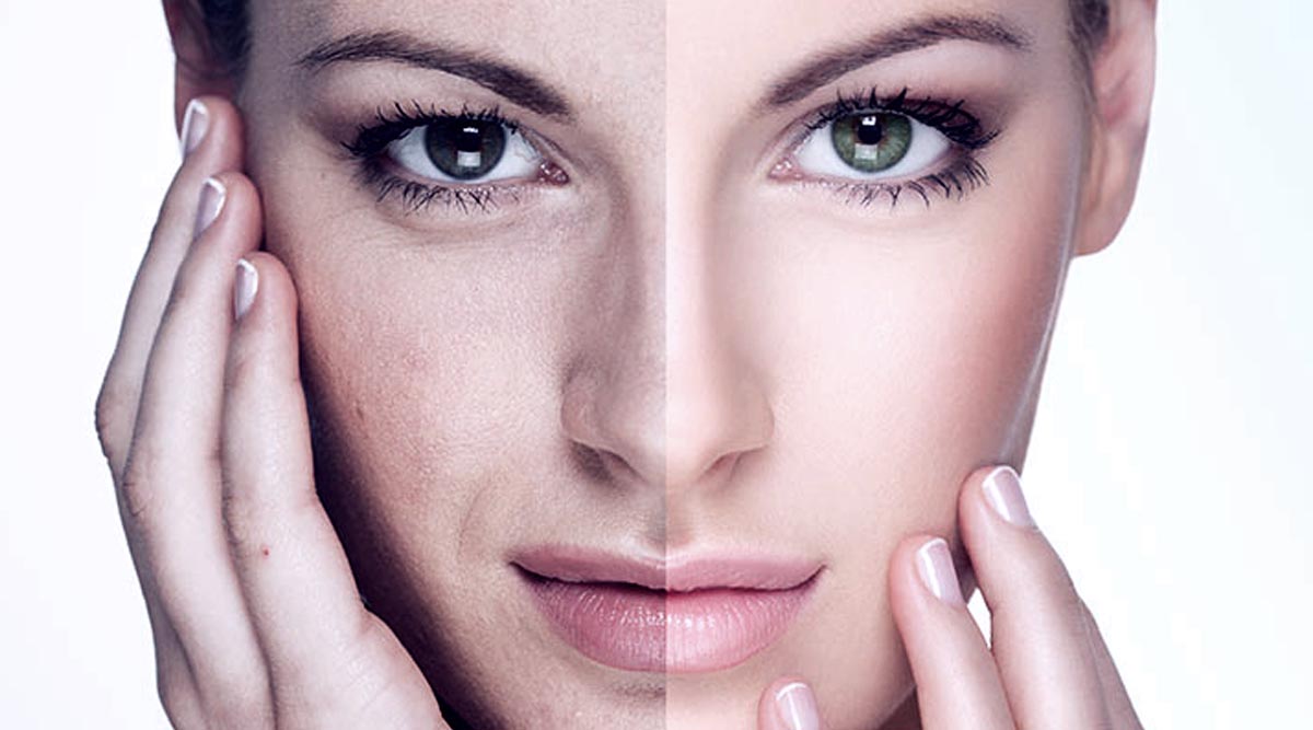 Fractional CO2 Laser