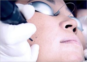 Fractional CO2 Laser 