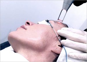 Fractional CO2 Laser 