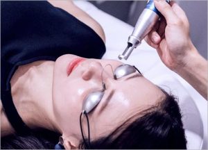 Fractional CO2 Laser 
