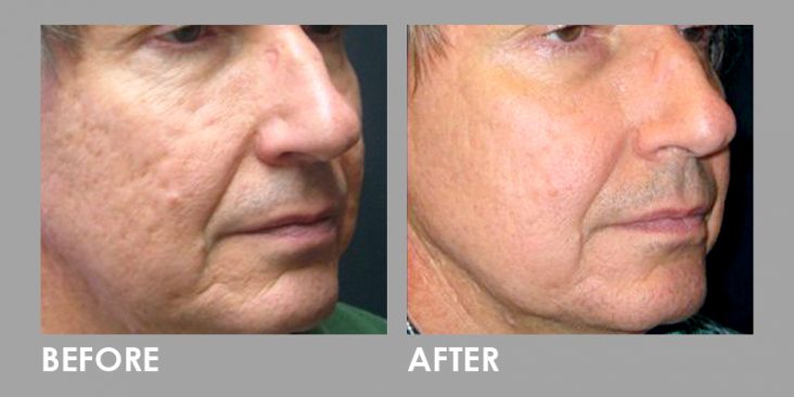 Before & After Fractional CO2 Laser Treatment