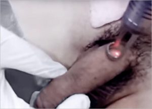 Genital Skin Whitening for Men
