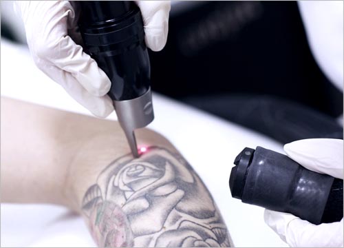 BENEFITS OF PICO LASER
