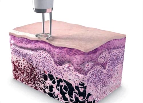 HOW DOES PICO LASER WORKS?