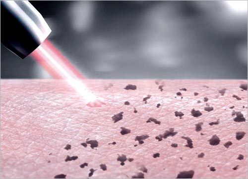 HOW DOES PICO LASER WORKS?