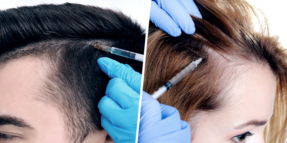 Hair Loss Treatments - Hair Filler