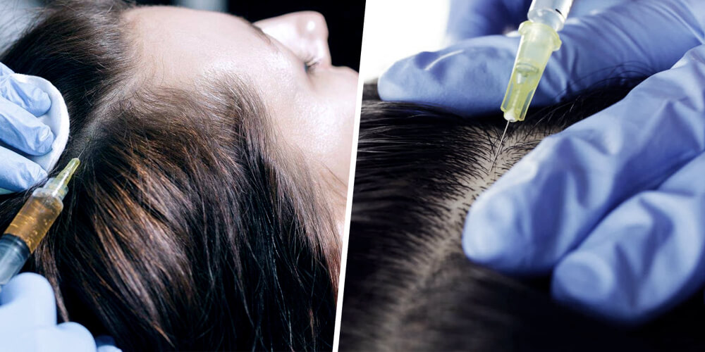 Hair Loss Treatments - Hair Mesotherapy