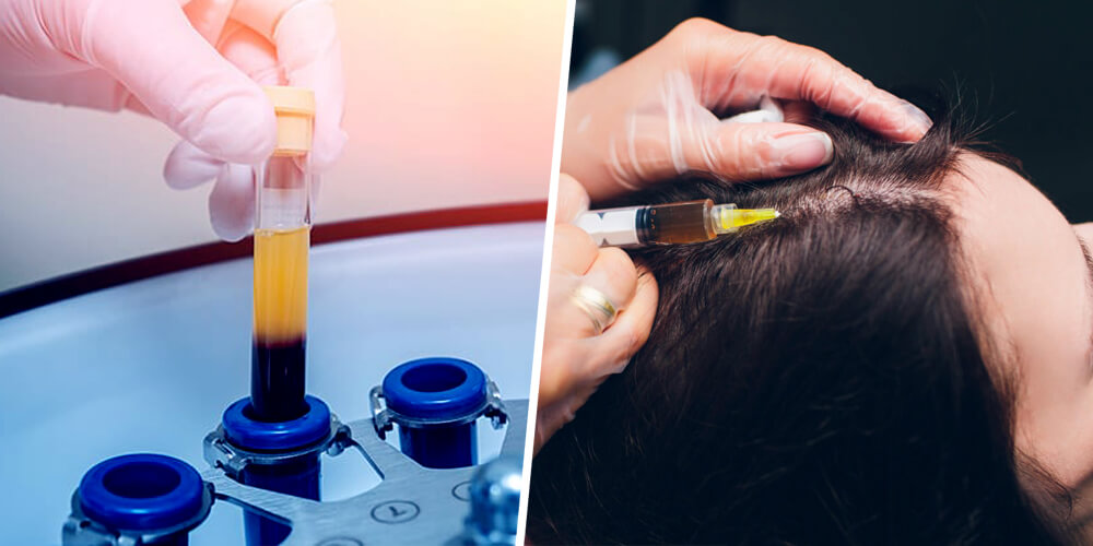 Hair Loss Treatments - Hair PRP