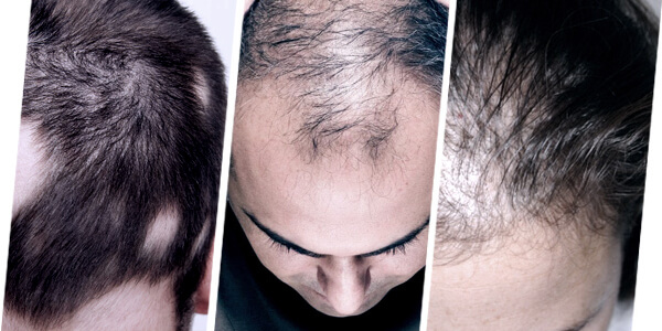 Hair PRP