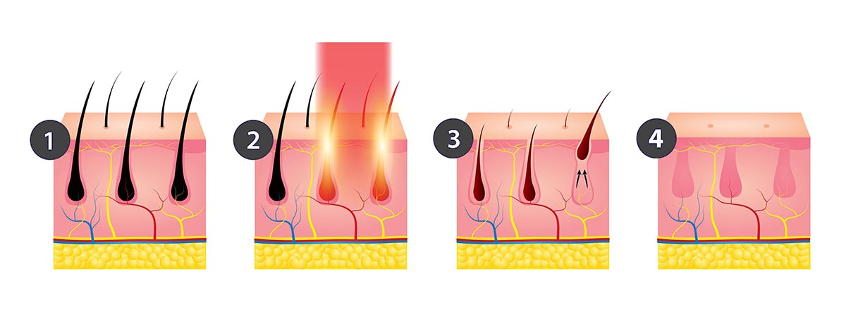 CANDELA GENTLE YAG LASER TREATMENT