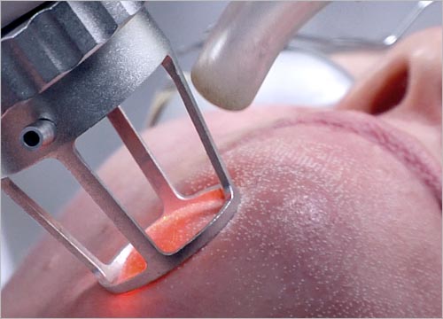 How Does the Fractional CO2 Laser Work