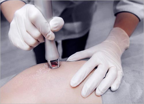 How Does the Fractional CO2 Laser Work