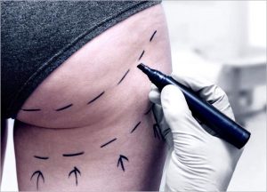 How does the Buttocks Augmentation work