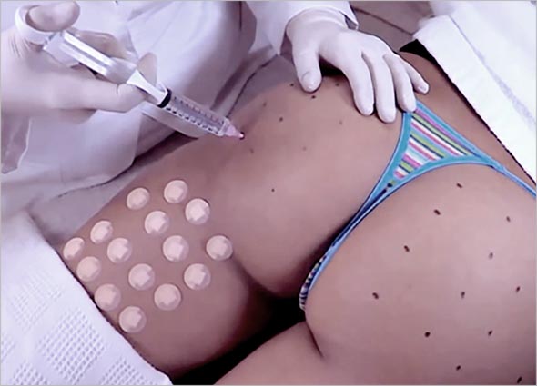 How does the Buttocks Augmentation work