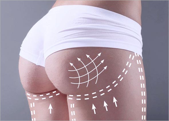 How does the Buttocks Augmentation work