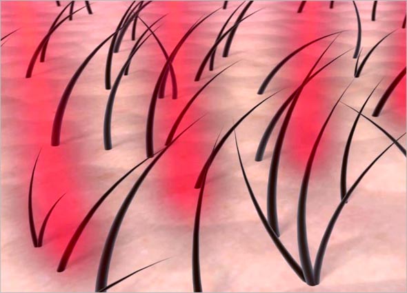 I-Grow Laser For Home Use: Hair Loss Treatment