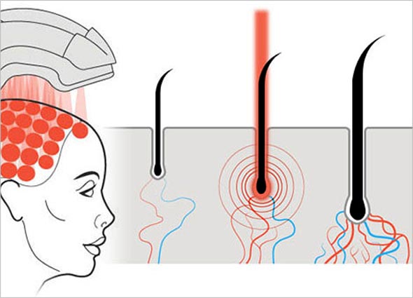 I-Grow Laser For Home Use: Hair Loss Treatment