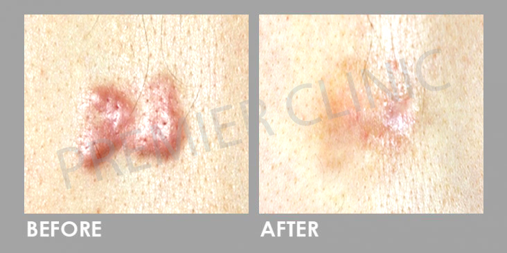 Before Keloid Scar Treatment & Removal