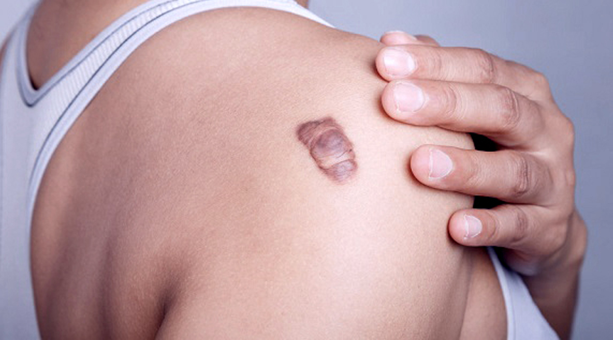 Keloid Scar Treatment & Removal