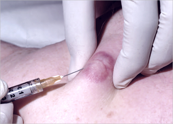 Keloid Scar Treatment & Removal