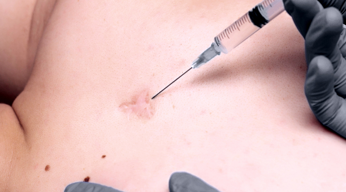 Keloid Scar Treatment & Removal 03